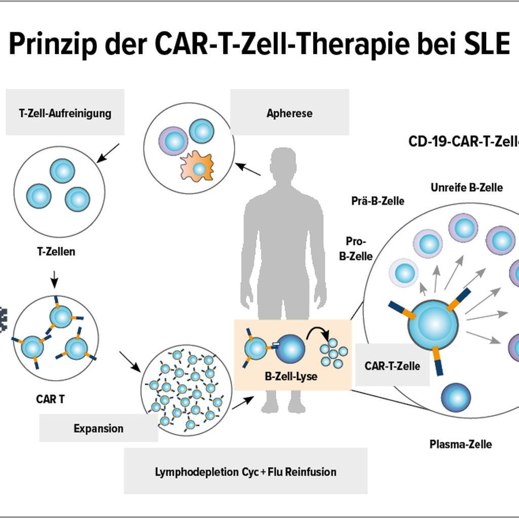 CAR T Zell Therapie Beim Systemischen Lupus Ein Neuer Meilenstein