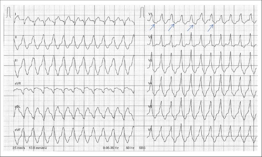 Ventrikuläre Tachykardie mit regelmässigen, unabhängig von den QRS-Komplexen auftretenden P-Wellen (Pfeile) entsprechend einer AV-Dissoziation