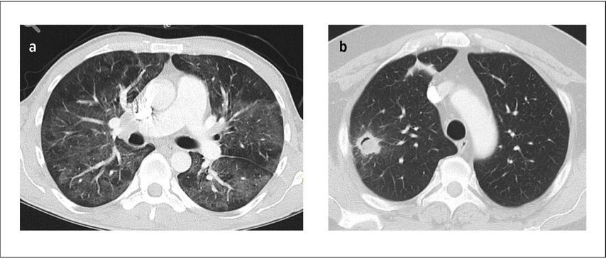 Thorax-CT mit Milchglasinfiltraten bei Pneumonie durch Pneumocystis jirovecii