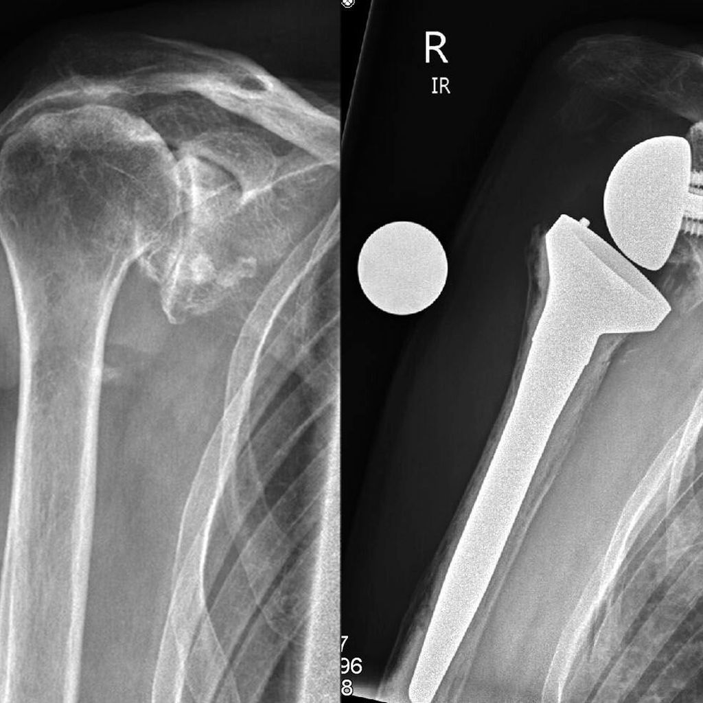 lateralisierung-bei-inverser-endoprothetik-der-schulter-orthop-die