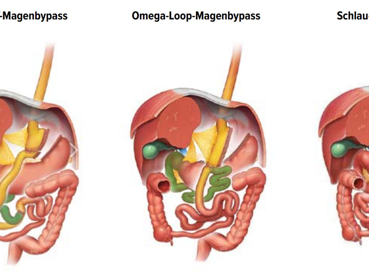 Medizinische Probleme nach Magenbypass