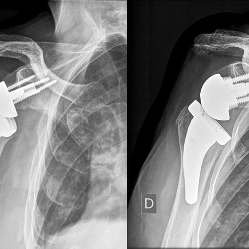 Patient-specific lateralization, glenoid offset, implications and oper ...