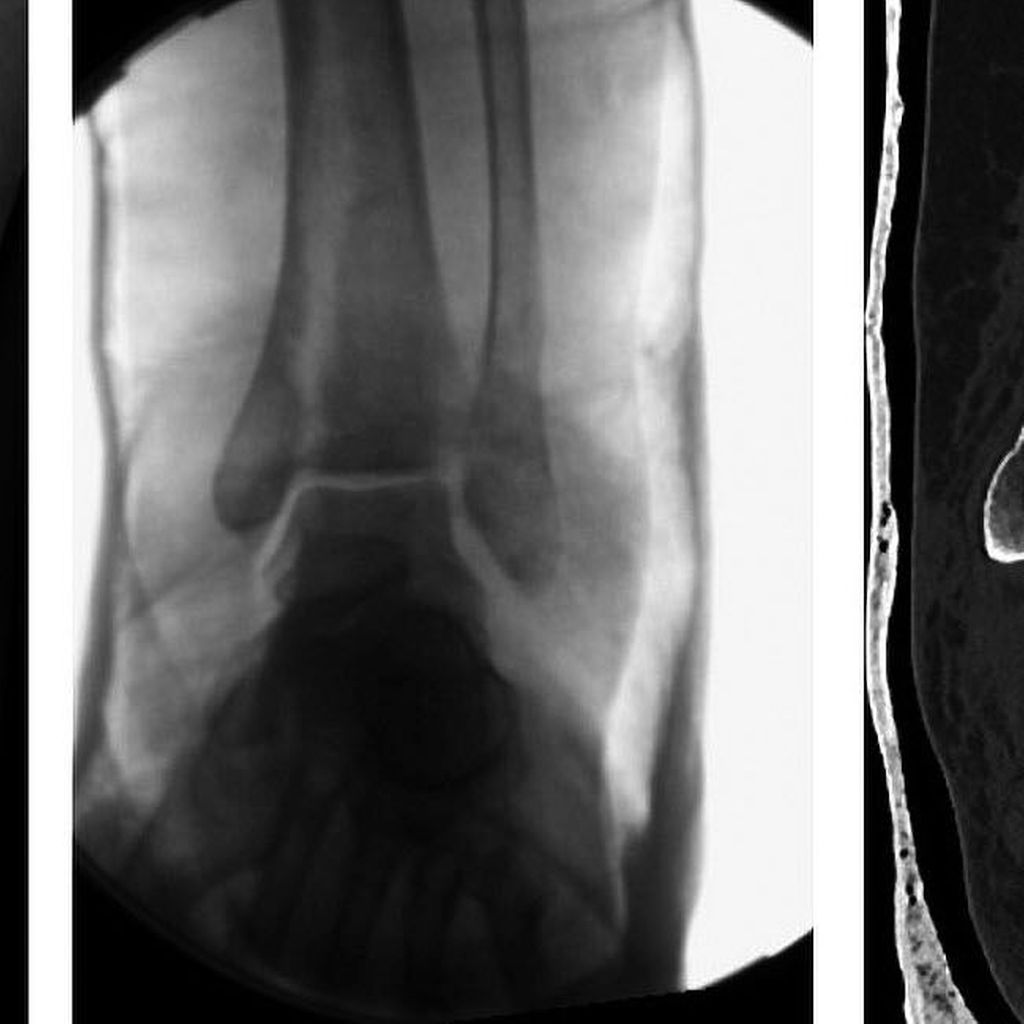 tempor-re-immobilisierung-im-gips-versus-fixateur-externe-bei-osg-luxa