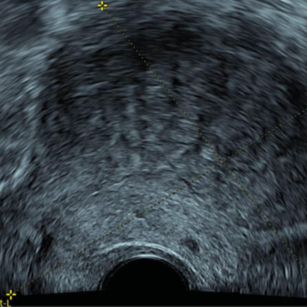 Differenzierte gynäkologische Sonografie: Adenomyose - Gynäkologie ...