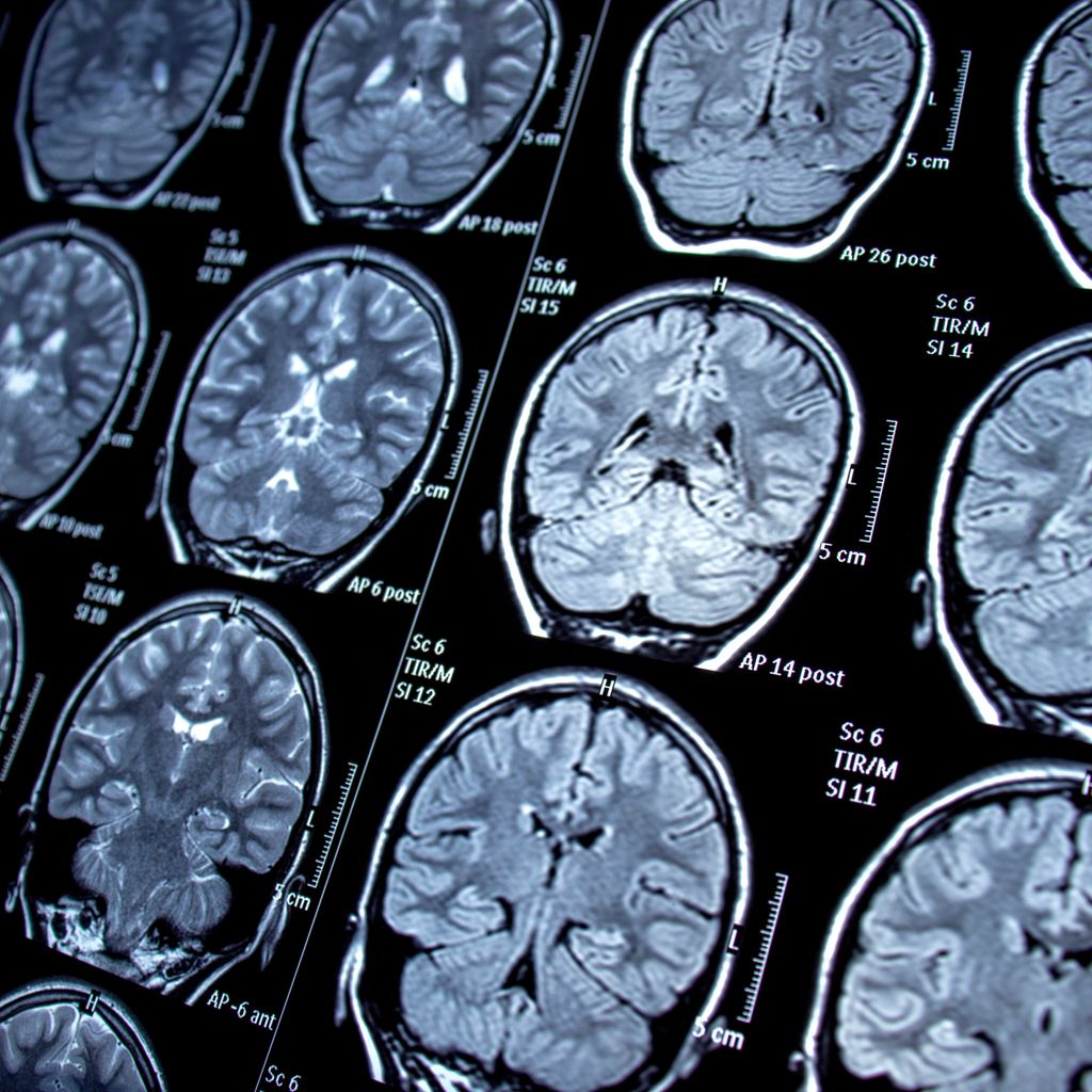 Die Multiple Sklerose Hat Offenbar Einen Längeren Vorlauf Als Wir Da Neurologie 7336