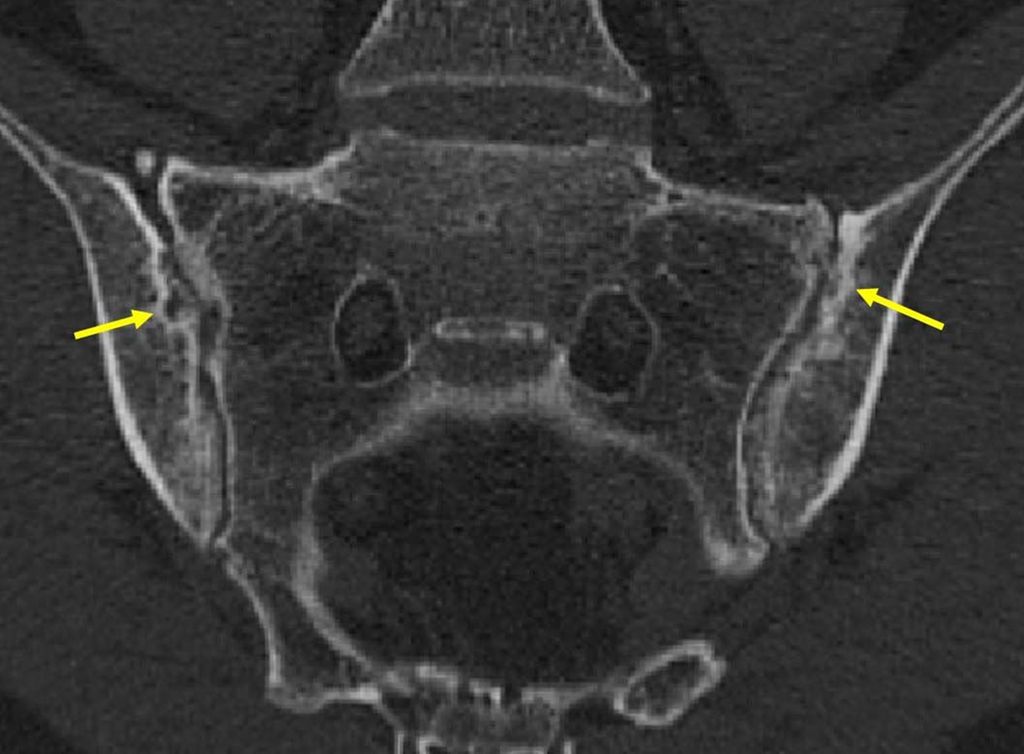 Сакроилеит на мрт фото