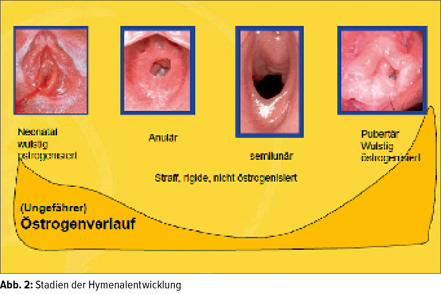 Wie sieht ein jungfernhäutchen aus bilder