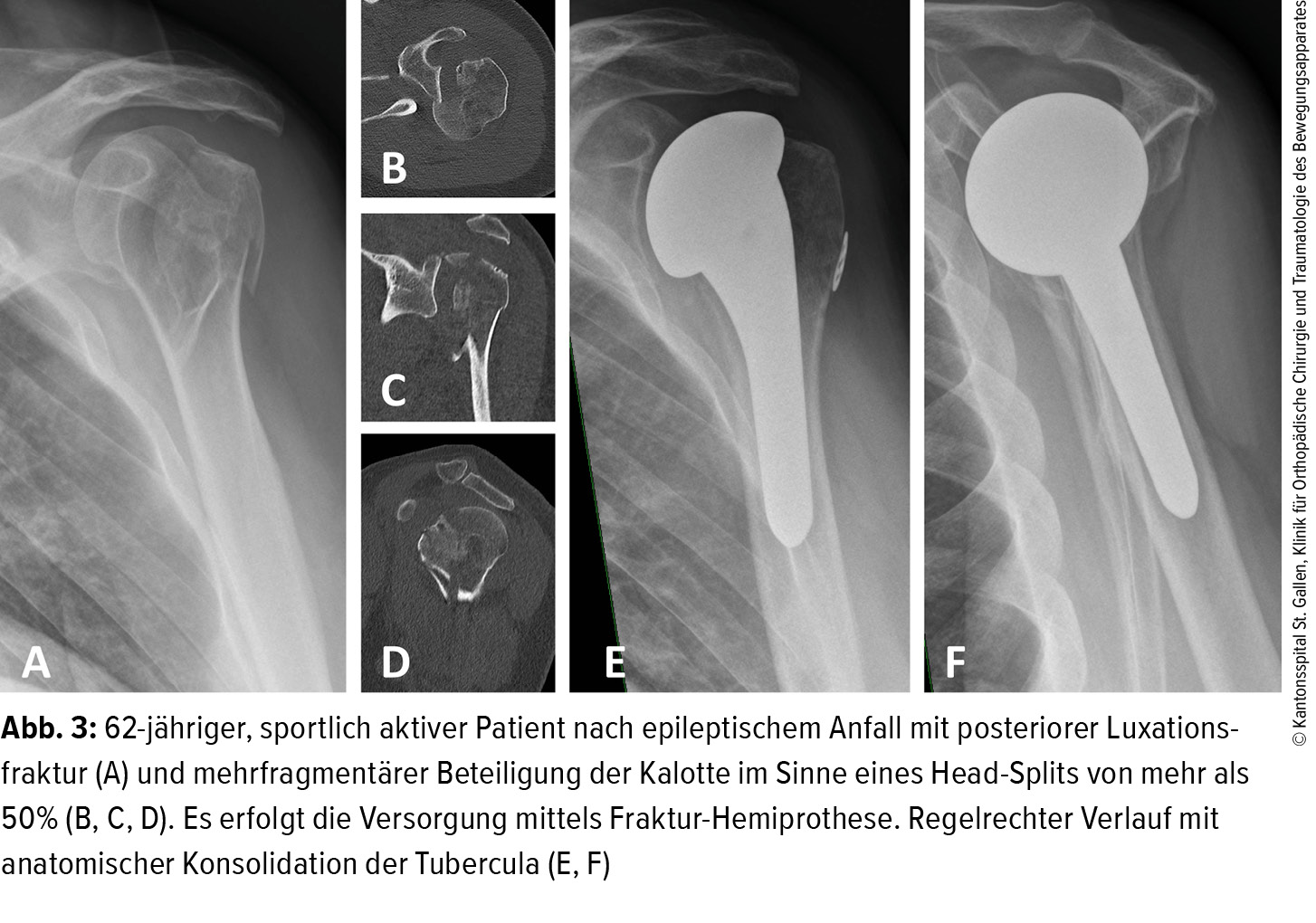 Fraktur des proximalen Humerus